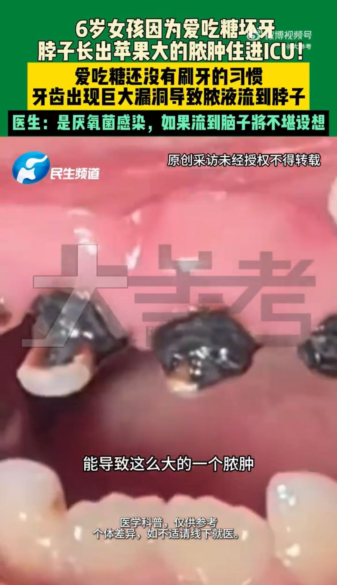 6岁女童因蛀牙脖子长巨型脓肿进ICU 图片2.jpg